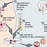 Etapas del procedimiento de FIV