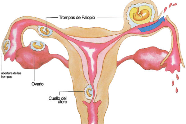 Embarazo extrauterino: ¿qué es y qué causas lo provocan?